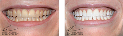 get your smile back with whiter teeth